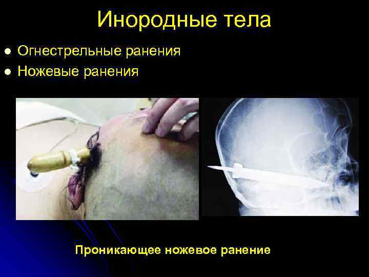 Инородные тела l l Огнестрельные ранения Ножевые ранения Проникающее ножевое ранение 
