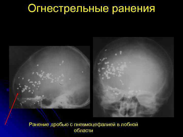 Огнестрельные ранения Ранение дробью с пневмоцефалией в лобной области 