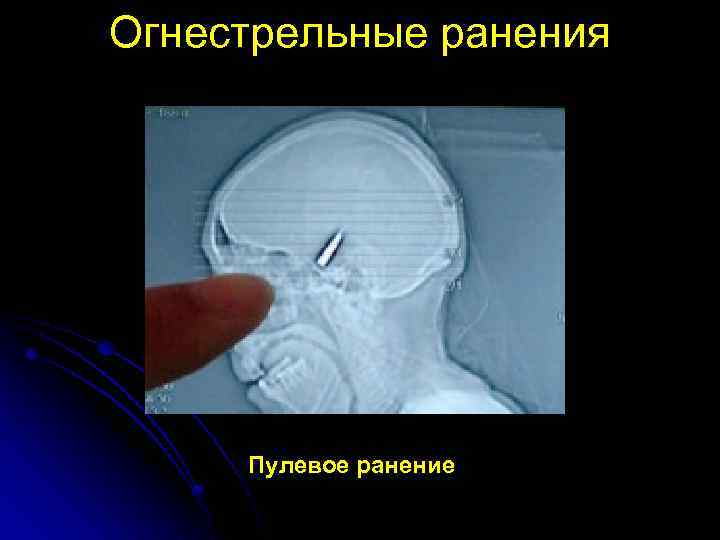 Огнестрельные ранения Пулевое ранение 