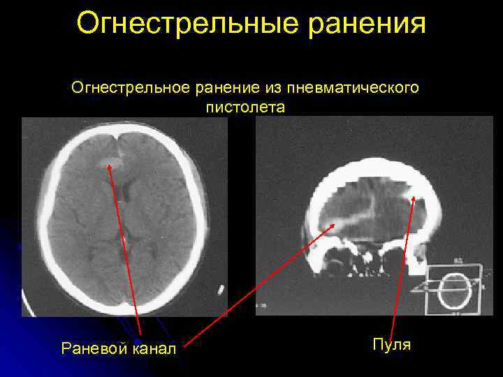 Огнестрельные ранения Огнестрельное ранение из пневматического пистолета Раневой канал Пуля 