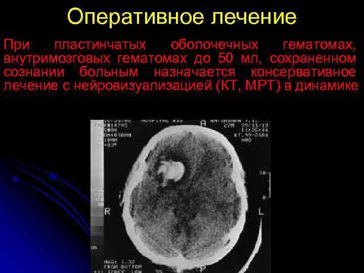 Оперативное лечение При пластинчатых оболочечных гематомах, внутримозговых гематомах до 50 мл, сохраненном сознании больным
