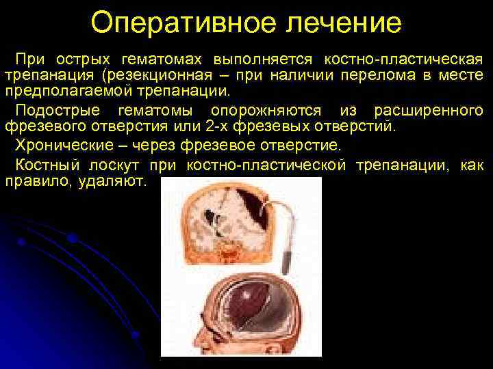Оперативное лечение При острых гематомах выполняется костно-пластическая трепанация (резекционная – при наличии перелома в