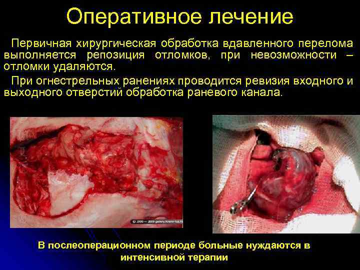 Оперативное лечение Первичная хирургическая обработка вдавленного перелома выполняется репозиция отломков, при невозможности – отломки