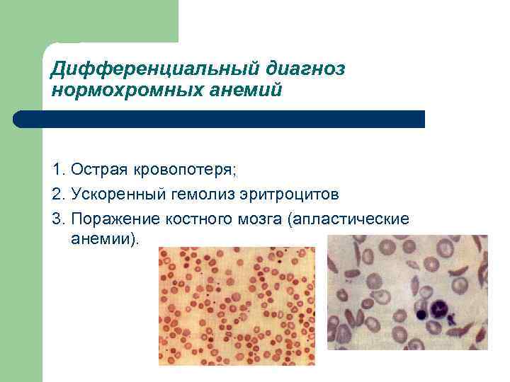 Дифференциальный диагноз нормохромных анемий 1. Острая кровопотеря; 2. Ускоренный гемолиз эритроцитов 3. Поражение костного