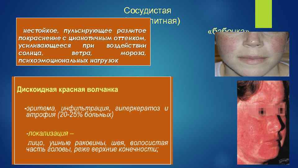Сосудистая (васкулитная) нестойкое, пульсирующее разлитое покраснение с цианотичным оттенком, усиливающееся при воздействии солнца, ветра,