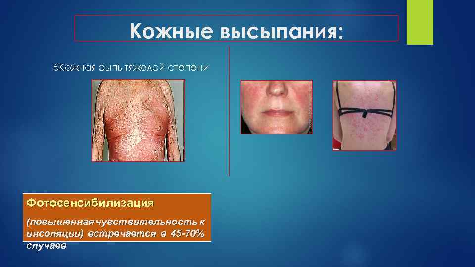 Кожные высыпания: 5 Кожная сыпь тяжелой степени Фотосенсибилизация (повышенная чувствительность к инсоляции) встречается в