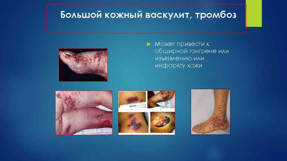 Большой кожный васкулит, тромбоз Может привести к обширной гангрене или изъязвлению или инфаркту кожи