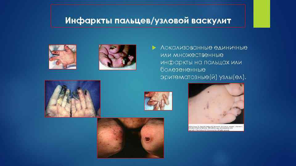 Инфаркты пальцев/узловой васкулит Локализованные единичные или множественные инфаркты на пальцах или болезененные эритематозные(й) узлы(ел).
