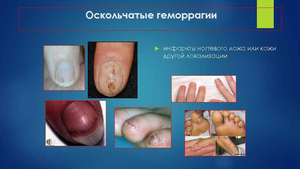 Оскольчатые геморрагии инфаркты ногтевого ложа или кожи другой локализации 