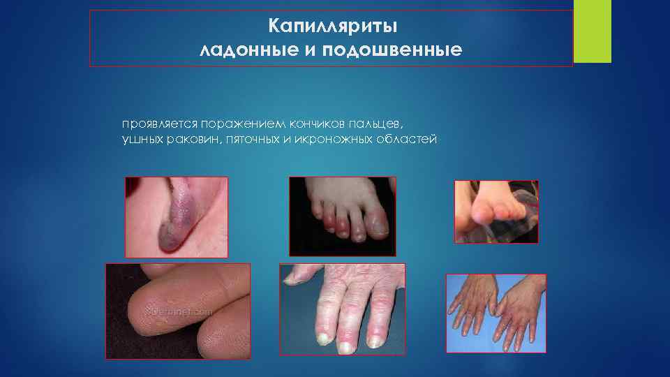 Капилляриты ладонные и подошвенные проявляется поражением кончиков пальцев, ушных раковин, пяточных и икроножных областей