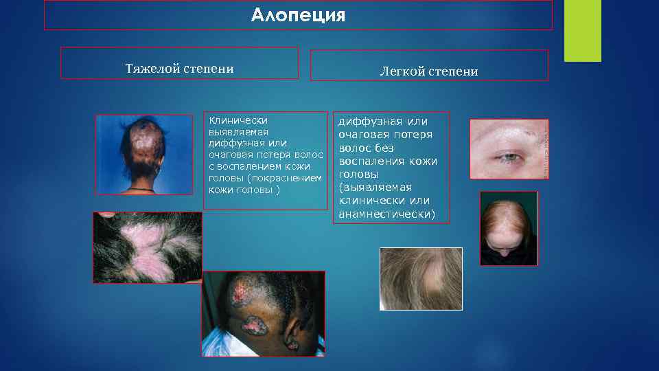 Алопеция Тяжелой степени Клинически выявляемая диффузная или очаговая потеря волос с воспалением кожи головы