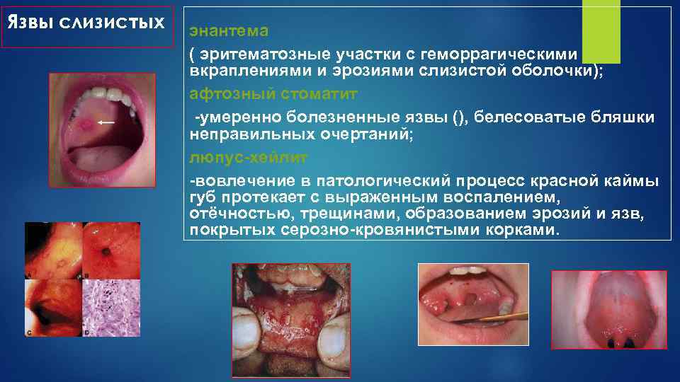 Язвы слизистых энантема ( эритематозные участки с геморрагическими вкраплениями и эрозиями слизистой оболочки); афтозный