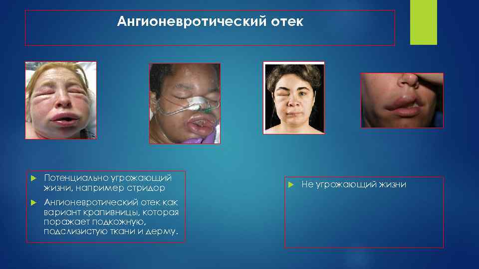 Ангионевротический отек Потенциально угрожающий жизни, например стридор Ангионевротический отек как вариант крапивницы, которая поражает
