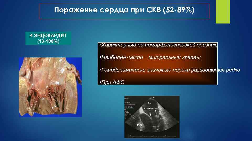 Поражение сердца при СКВ (52 -89%) 4. ЭНДОКАРДИТ (13 -100%) • Характерный патоморфологический признак;