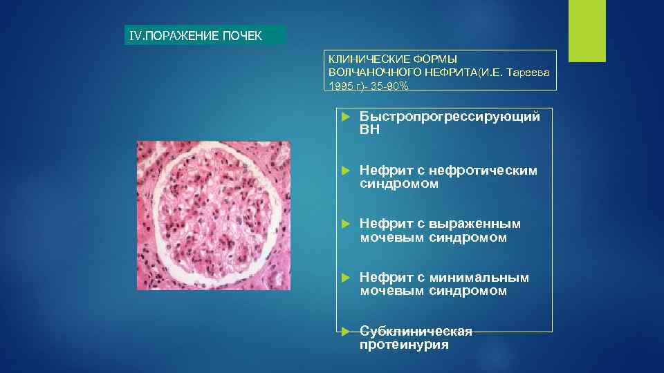 IV. ПОРАЖЕНИЕ ПОЧЕК КЛИНИЧЕСКИЕ ФОРМЫ ВОЛЧАНОЧНОГО НЕФРИТА(И. Е. Тареева 1995 г)- 35 -90% Быстропрогрессирующий