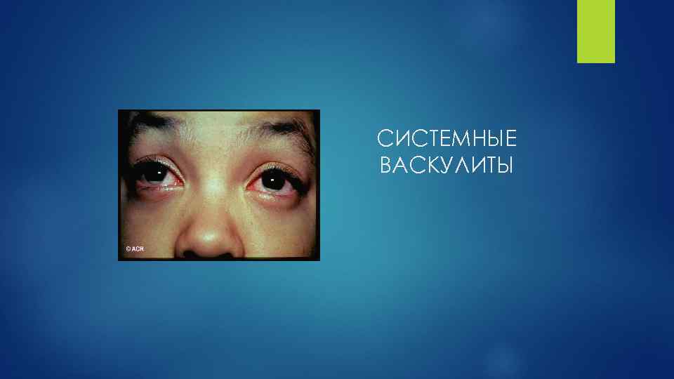 СИСТЕМНЫЕ ВАСКУЛИТЫ 