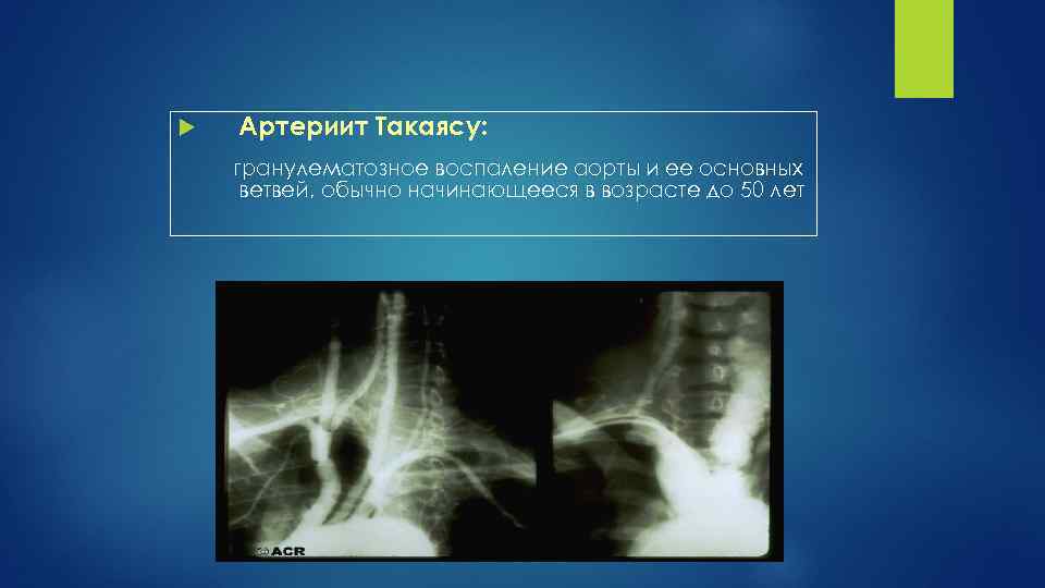  Артериит Такаясу: гранулематозное воспаление аорты и ее основных ветвей, обычно начинающееся в возрасте