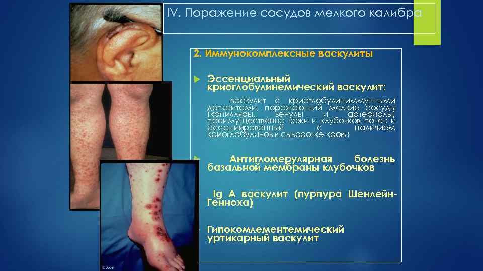 IV. Поражение сосудов мелкого калибра 2. Иммунокомплексные васкулиты Эссенциальный криоглобулинемический васкулит: васкулит с криоглобулиниммунными