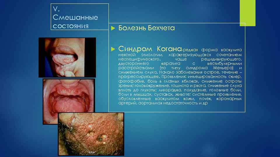 V. Cмешанные состояния Болезнь Бехчета Синдром Когана редкая форма васкулита неясной этиологии, характеризующаяся сочетанием