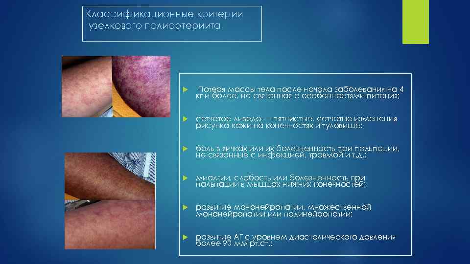Классификационные критерии узелкового полиартериита Потеря массы тела после начала заболевания на 4 кг и