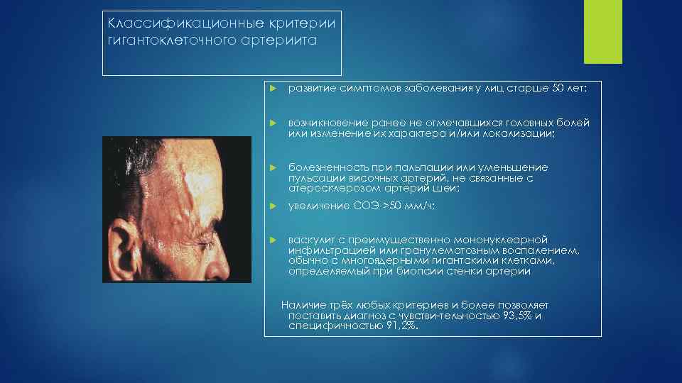 Классификационные критерии гигантоклеточного артериита развитие симптомов заболевания у лиц старше 50 лет; возникновение ранее