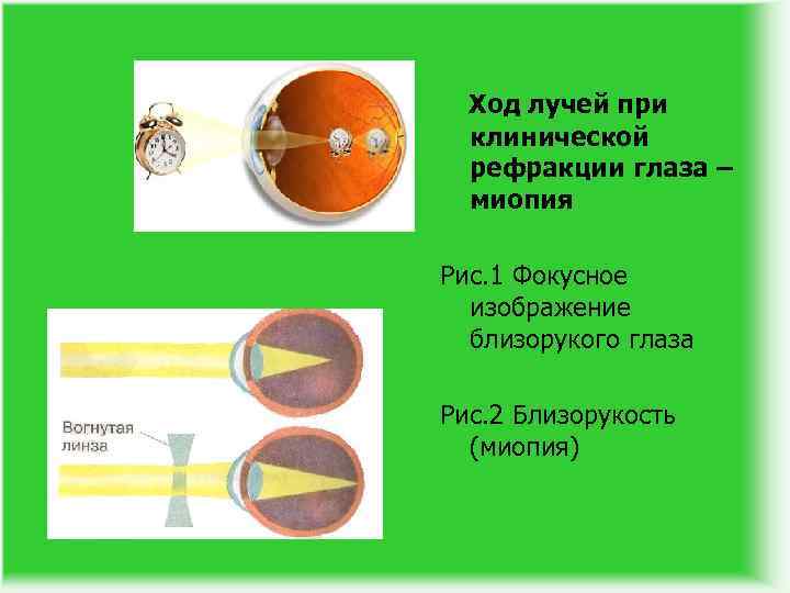 Ход лучей при клинической рефракции глаза – миопия Рис. 1 Фокусное изображение близорукого глаза