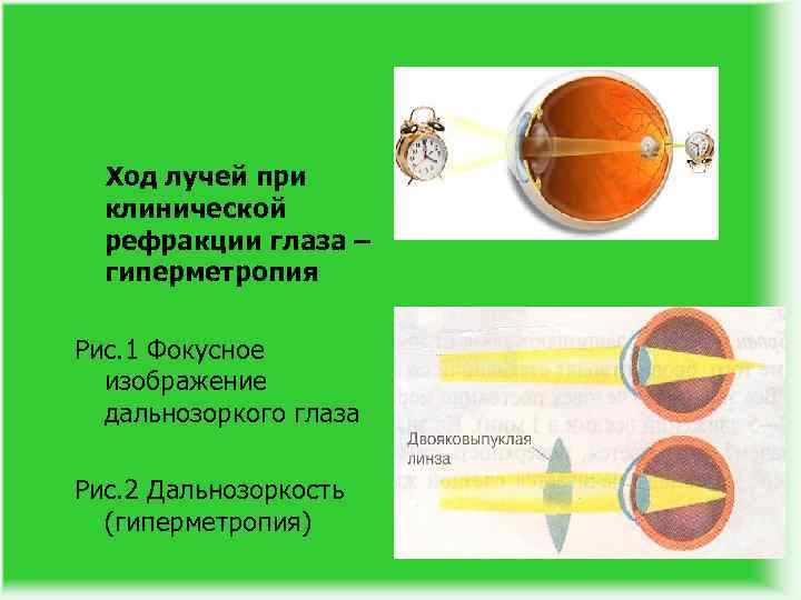Ход лучей при клинической рефракции глаза – гиперметропия Рис. 1 Фокусное изображение дальнозоркого глаза