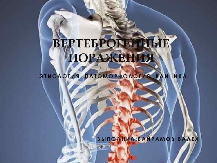 ВЕРТЕБРОГЕННЫЕ ПОРАЖЕНИЯ ЭТИОЛОГИЯ , ПАТОМОРФОЛОГИЯ , КЛИНИКА ВЫПОЛНИЛ: БАЙРАМОВ ВАЛЕХ 