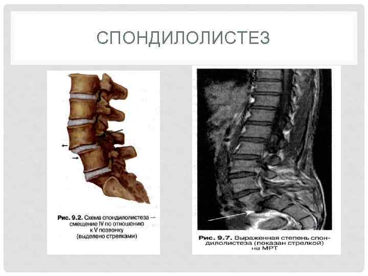 СПОНДИЛОЛИСТЕЗ 