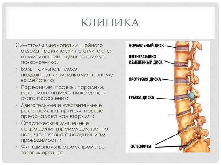 Грудной отдел позвоночника симптомы. Вертеброгенная миелопатия грудного отдела. Миелопатия грудного отдела позвоночника. Миелопатия шейно-грудного отдела позвоночника. Вертеброгенная шейная миелопатия.