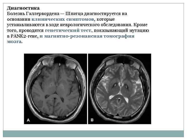 Диагностика Болезнь Галлервордена — Шпатца диагностируется на основании клинических симптомов, которые устанавливаются в ходе