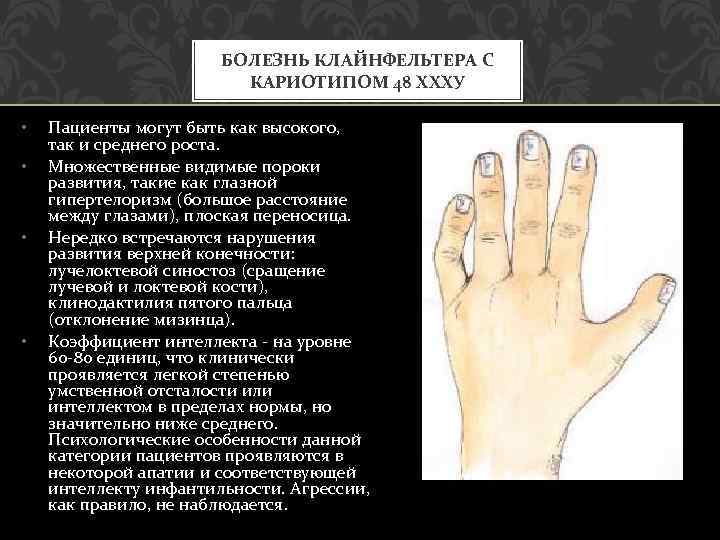 БОЛЕЗНЬ КЛАЙНФЕЛЬТЕРА С КАРИОТИПОМ 48 ХХХУ • • Пациенты могут быть как высокого, так