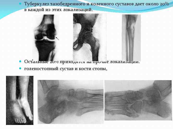  Туберкулез тазобедренного и коленного суставов дает около 20% в каждой из этих локализаций.