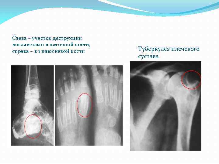 Слева – участок деструкции локализован в пяточной кости, справа – в 1 плюсневой кости