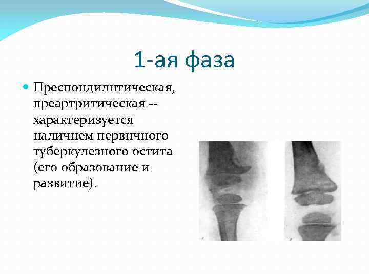 1 -ая фаза Преспондилитическая, преартритическая -- характеризуется наличием первичного туберкулезного остита (его образование и