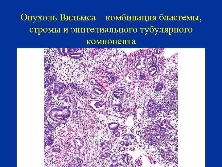 Опухоль Вильмса – комбинация бластемы, стромы и эпителиального тубулярного компонента 