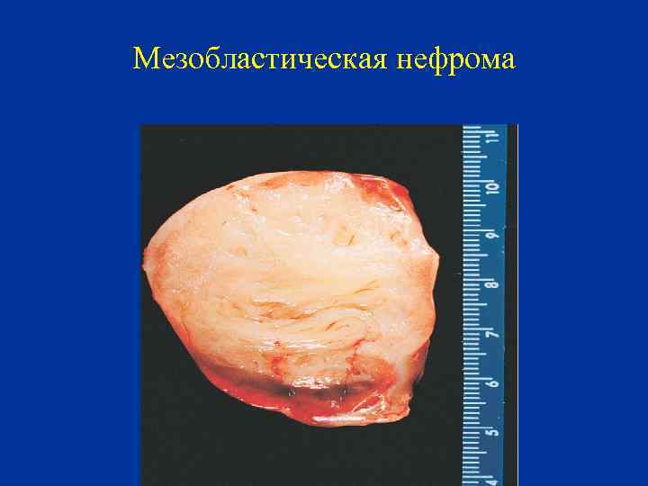 Мезобластическая нефрома 