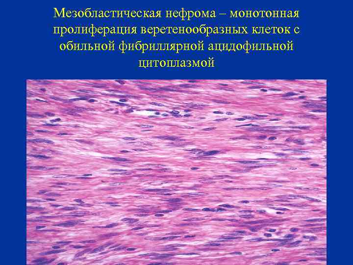 Мезобластическая нефрома – монотонная пролиферация веретенообразных клеток с обильной фибриллярной ацидофильной цитоплазмой 