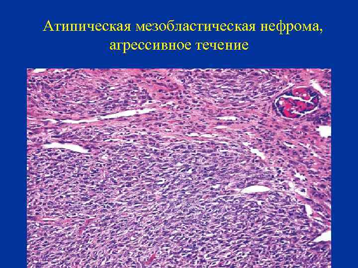 Атипическая мезобластическая нефрома, агрессивное течение 