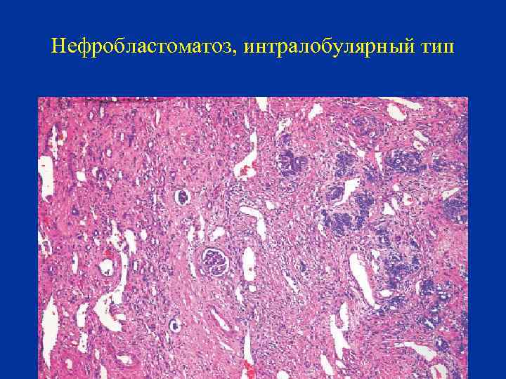 Нефробластоматоз, интралобулярный тип 