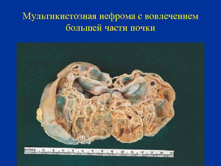 Мультикистозная нефрома с вовлечением большей части почки 