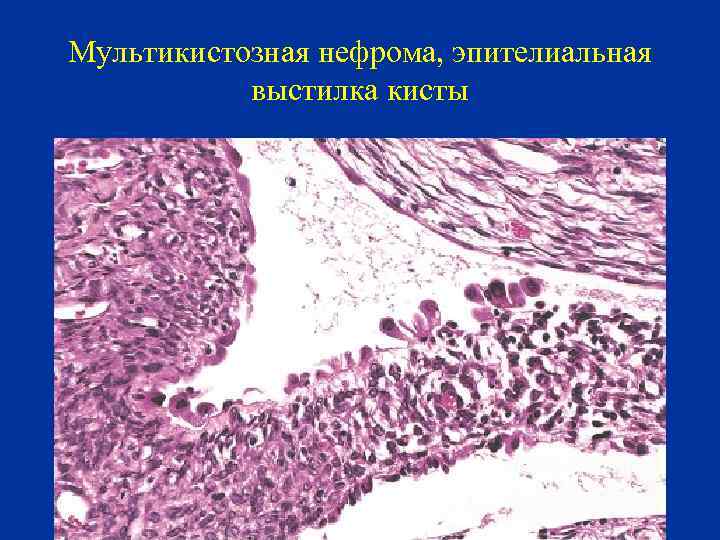 Мультикистозная нефрома, эпителиальная выстилка кисты 