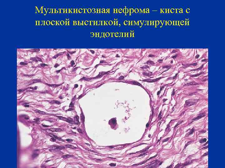 Мультикистозная нефрома – киста с плоской выстилкой, симулирующей эндотелий 