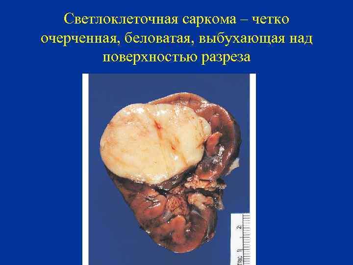 Светлоклеточная саркома – четко очерченная, беловатая, выбухающая над поверхностью разреза 