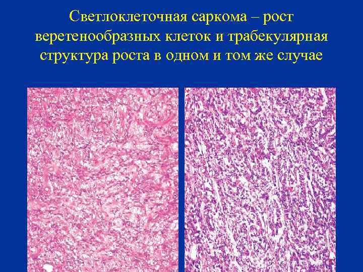 Светлоклеточная саркома – рост веретенообразных клеток и трабекулярная структура роста в одном и том