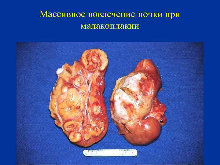 Массивное вовлечение почки при малакоплакии 