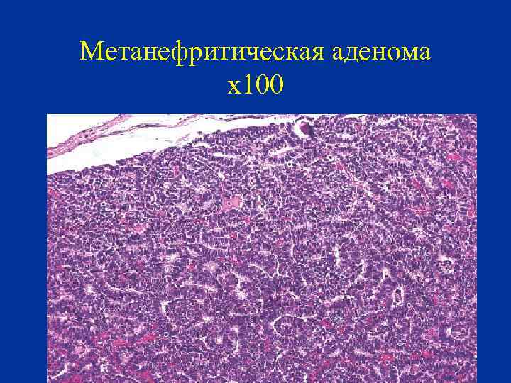 Метанефритическая аденома х100 