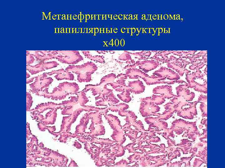 Метанефритическая аденома, папиллярные структуры х400 