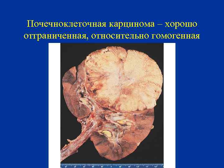 Почечноклеточная карцинома – хорошо отграниченная, относительно гомогенная 