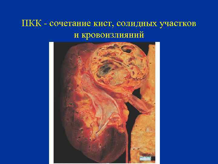 ПКК - сочетание кист, солидных участков и кровоизлияний 